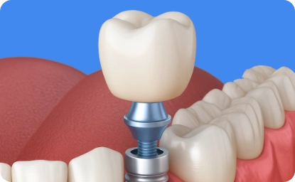 implantologia dentale - impianti dentali udine e codroipo - friuldent